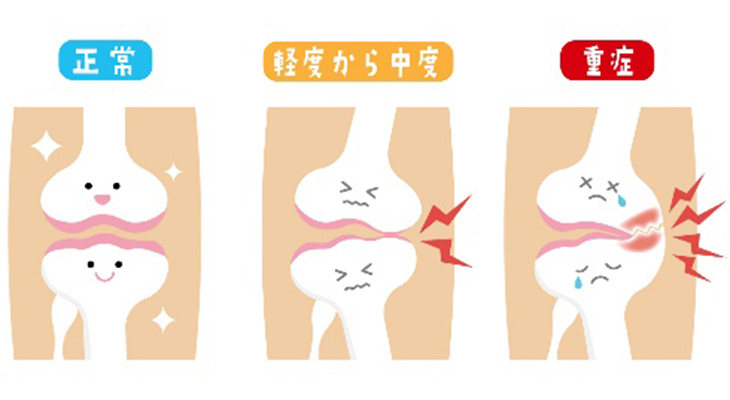 膝の疾患イメージ2